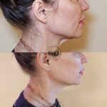 EVO Beauty Clinics presenta Ultraformer MPT: la última revolución enlifting y remodelación no invasiva